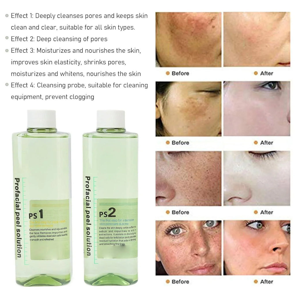 4pcs Hydra Peeling Facial Serum for Dermabrasion Device Deep Cleansing Hydro Dermabrasion Solution Daily Skin Care Brightening and Hydrating Facial Serum