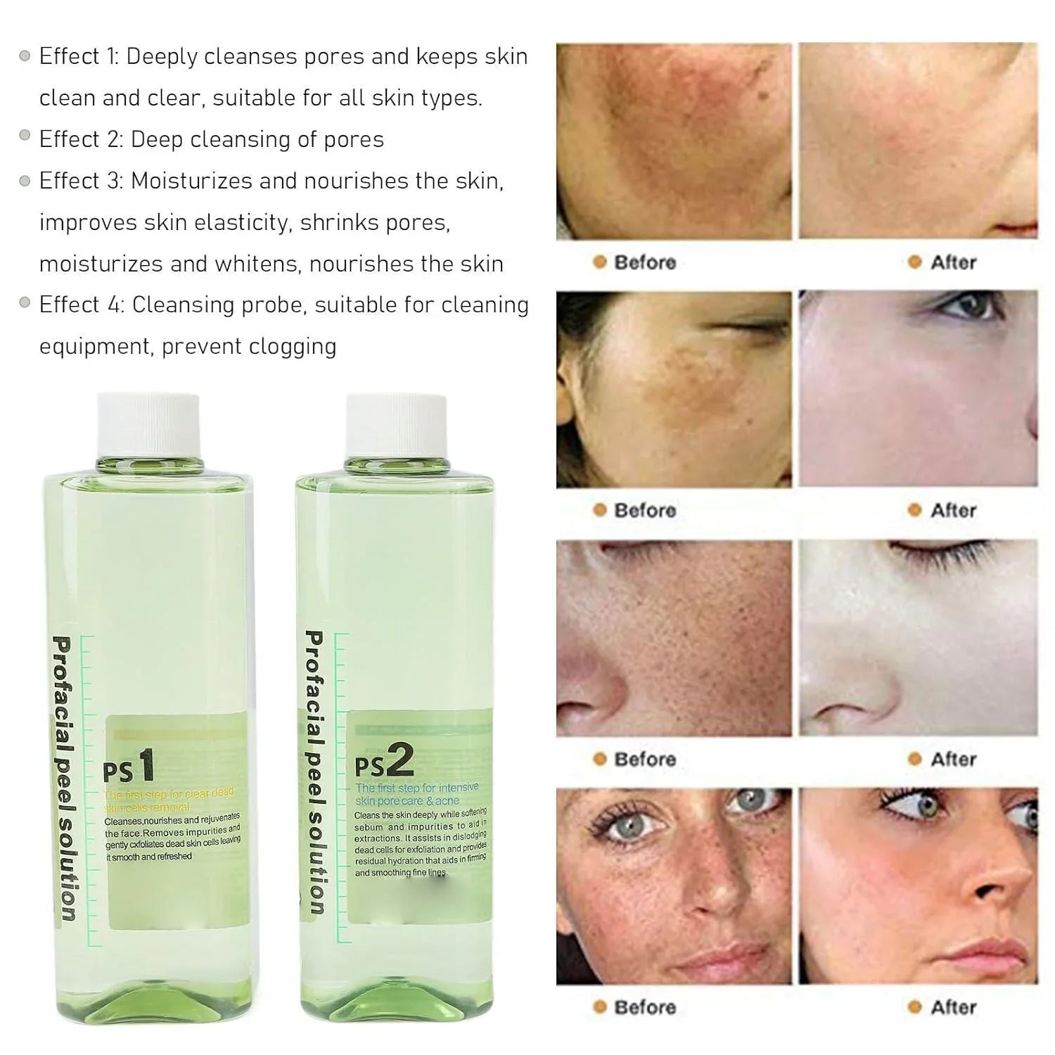 4pcs Hydra Peeling Facial Serum for Dermabrasion Device Deep Cleansing Hydro Dermabrasion Solution Daily Skin Care Brightening and Hydrating Facial Serum