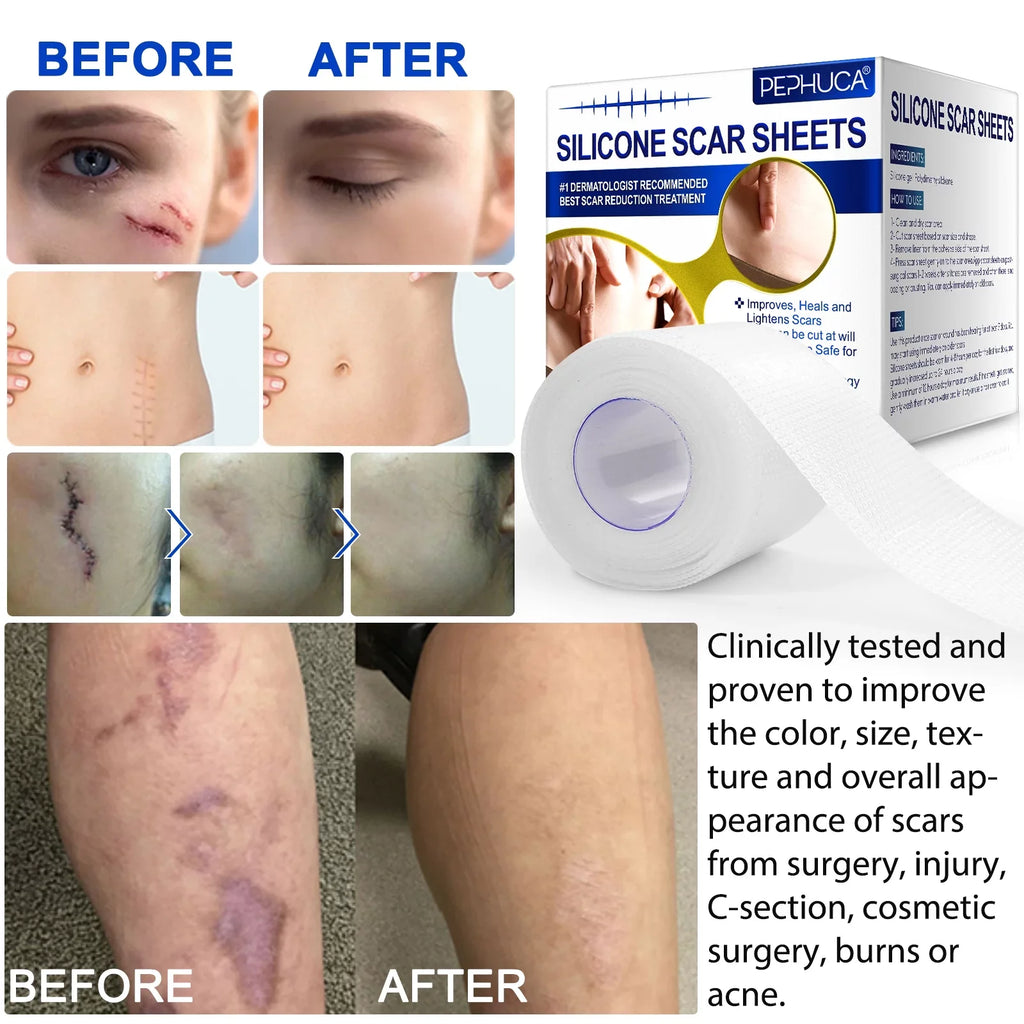 Pephuca Medical Grade Silicone Scar Sheets;Reusable and Breathable Silicone Gel Tape for Scar Removal;120inch x 1.6inch Roll Reusable 6 Months Supply;Transparent - 2 Pack
